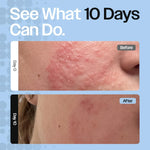 Skin Barrier Repair Cream for Eczema, Rosacea, Sensitive Dry Skin. Hydrating moisturizer, eczema relief cream soothes dry skin and redness. Face moisturizer & body cream for daily/nighttime use