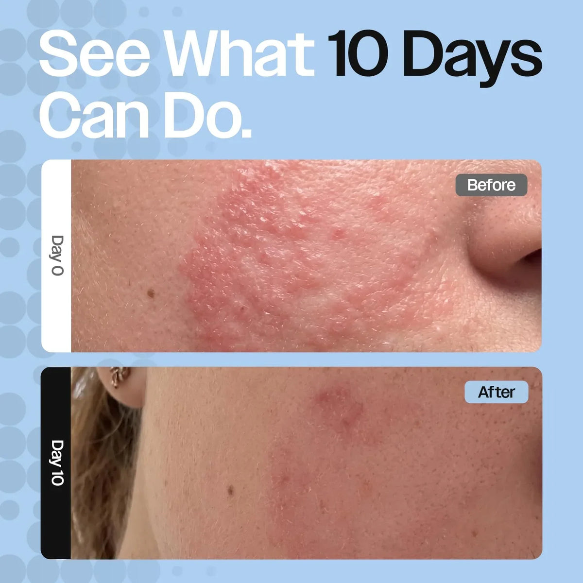Skin Barrier Repair Cream for Eczema, Rosacea, Sensitive Dry Skin. Hydrating moisturizer, eczema relief cream soothes dry skin and redness. Face moisturizer & body cream for daily/nighttime use
